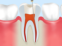 重度のむし歯は根管治療で治します
