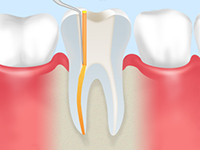重度のむし歯は根管治療で治します