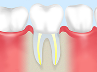 重度のむし歯は根管治療で治します