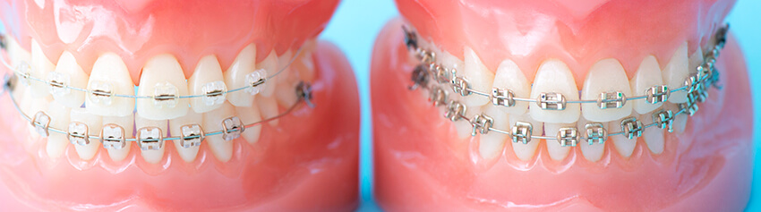 きれいな歯並びがむし歯や歯周病を予防します